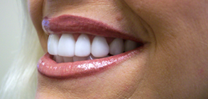 Full Mouth Dental Implants