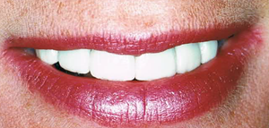 Cosmetic Dental Treatment
