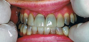 Cosmetic Dentist Davidson NC