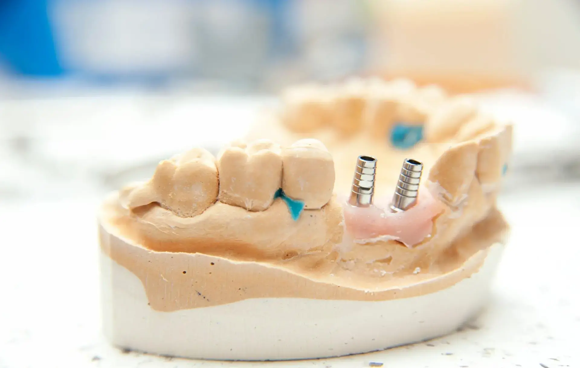 Skotzko Family Dental Clinic|Dental Implants