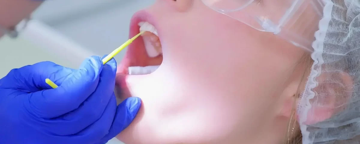 Dental Veneers Implant