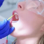 Dental Veneers Implant