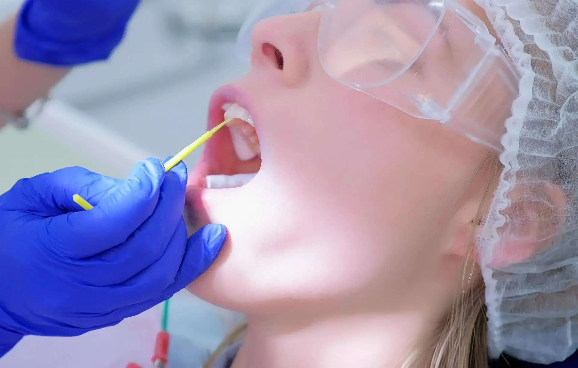 Dental Veneers Implant