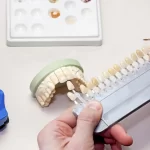 Dental Veneers Implant