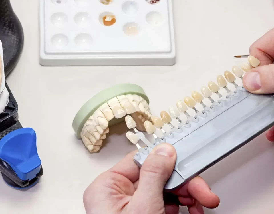 Dental Veneers Implant