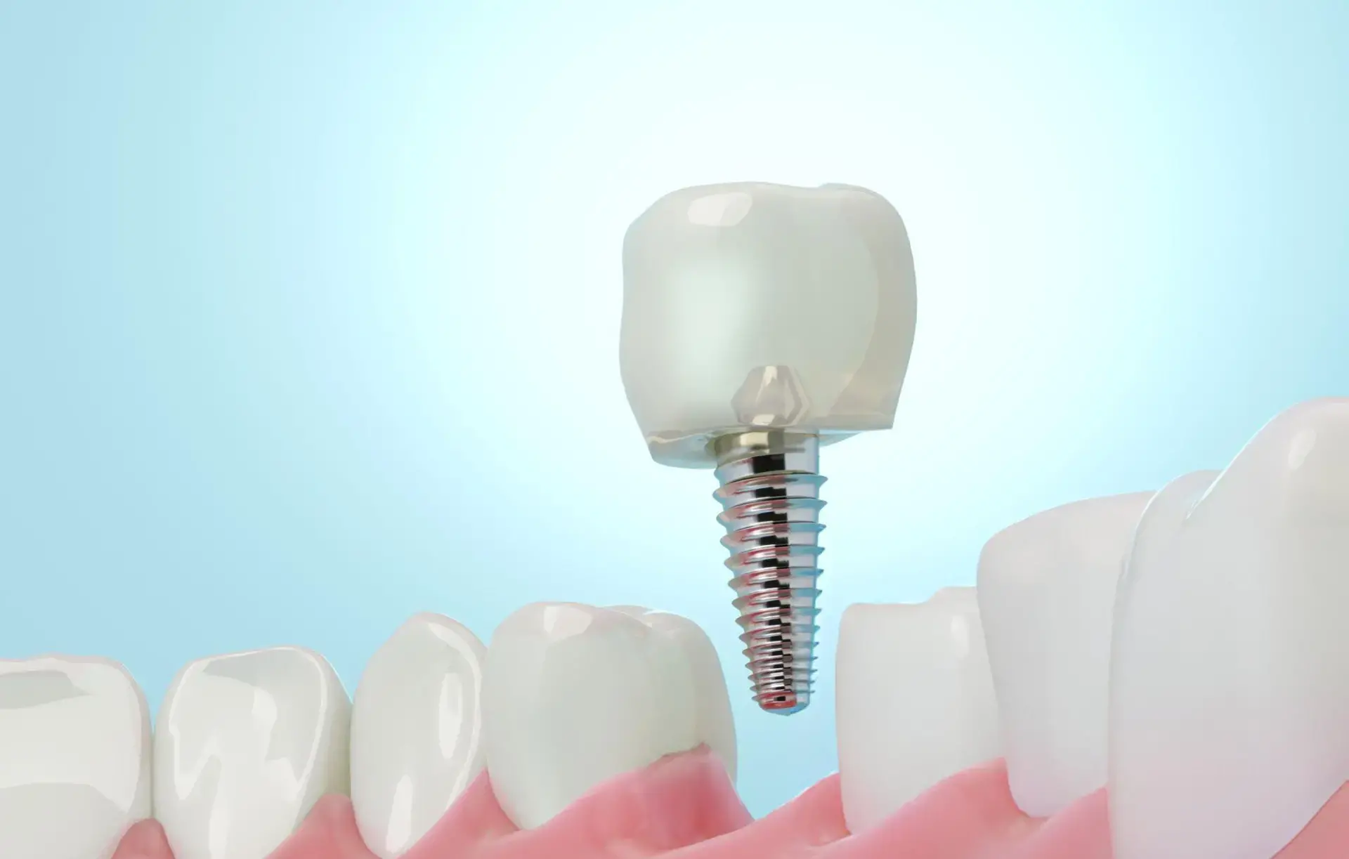 Over-Denture Implant Service