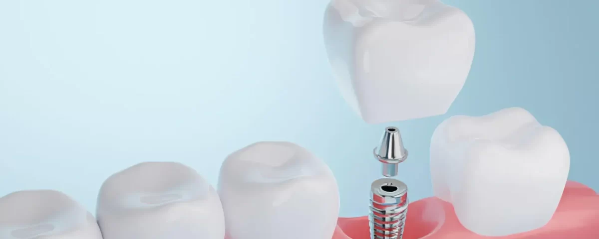 Over-Denture Implants