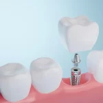 Over-Denture Implants