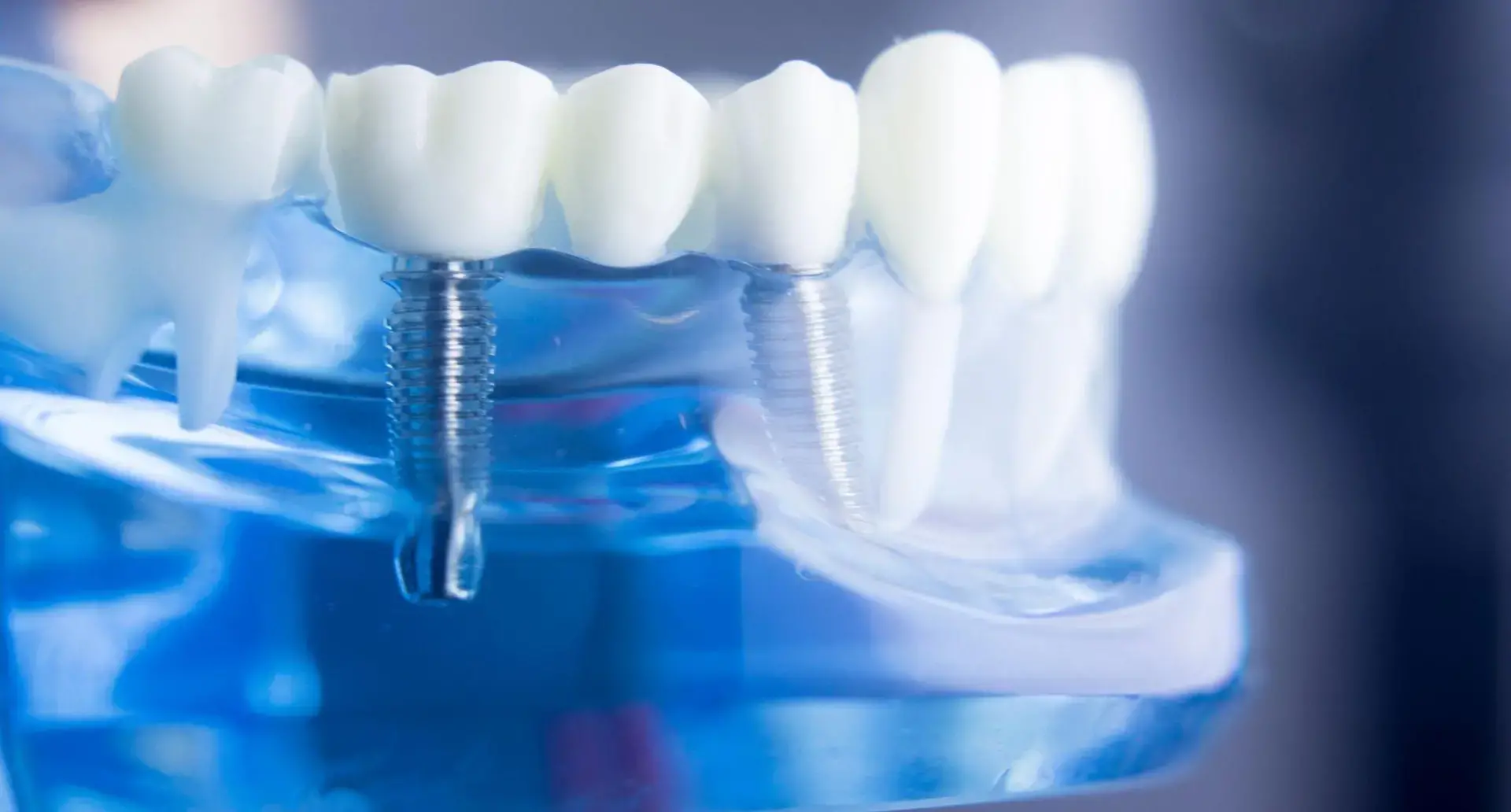 Full Arch Dental Implant 