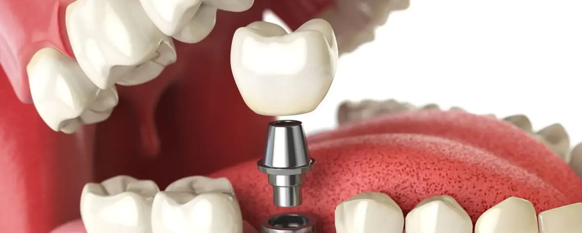 All on X Dental Implant