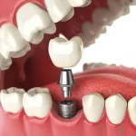 All on X Dental Implant