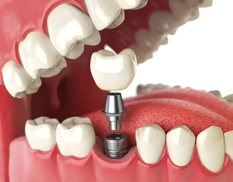 All on X Dental Implant