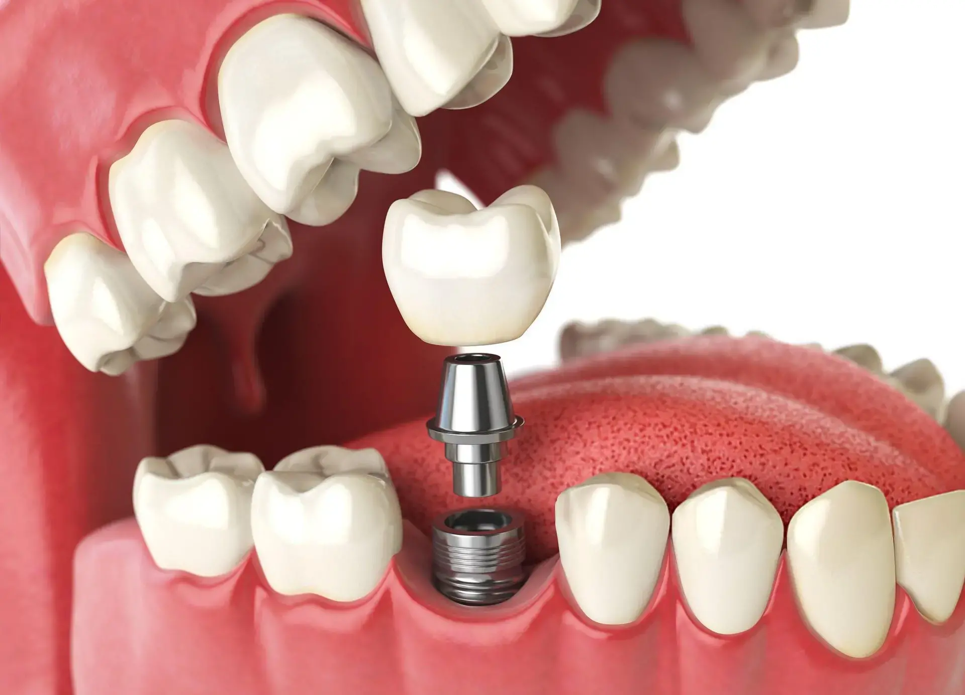 All on X Dental Implant