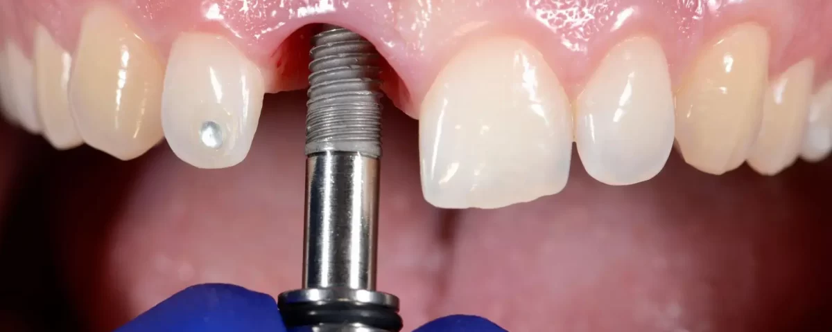 All on X Dental Implant Service