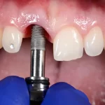 All on X Dental Implant Service