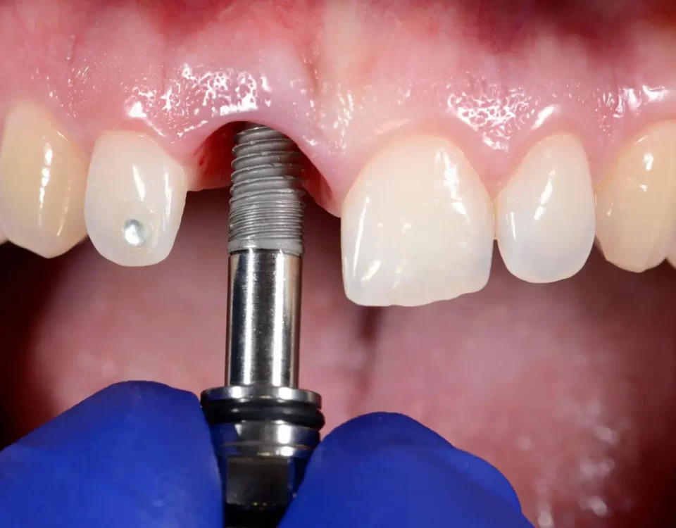 All on X Dental Implant Service