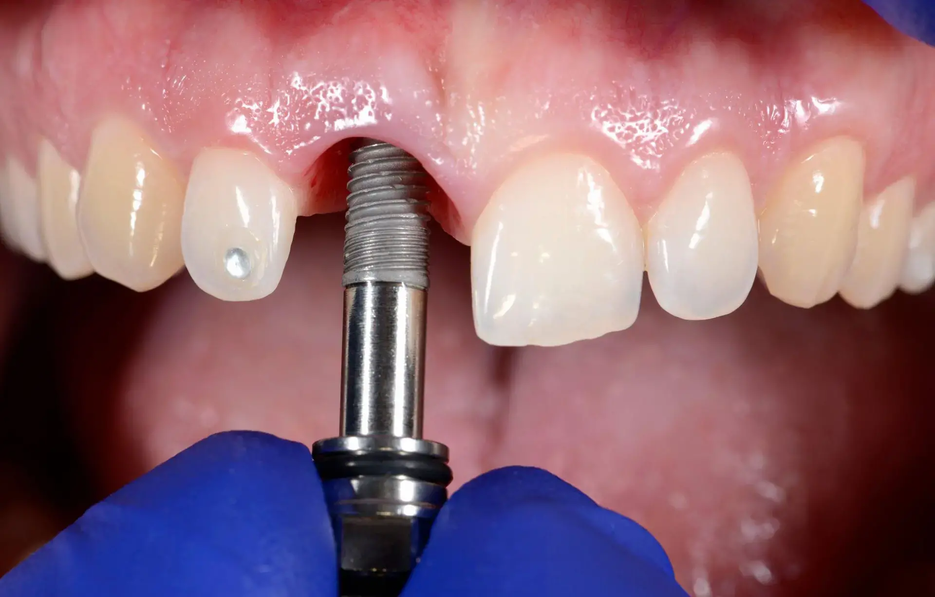All on X Dental Implant Service