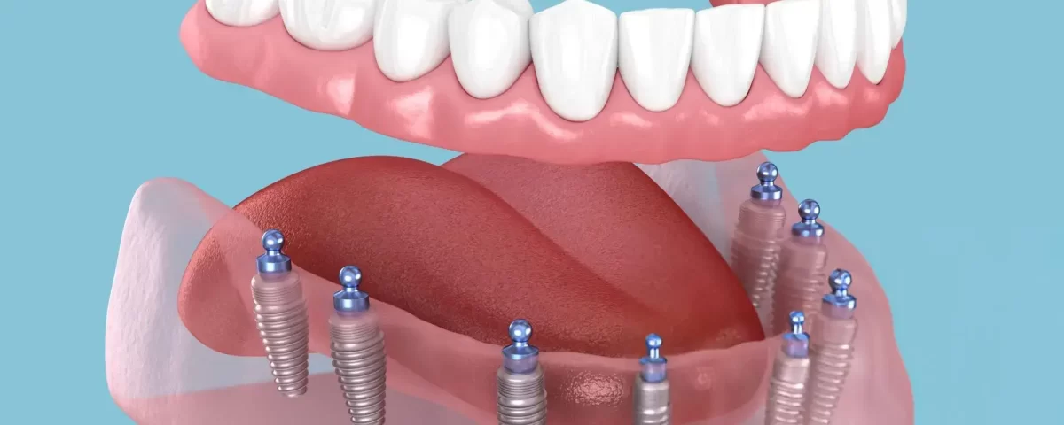 Full Dental Implants Costs