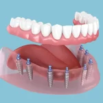 Full Dental Implants Costs