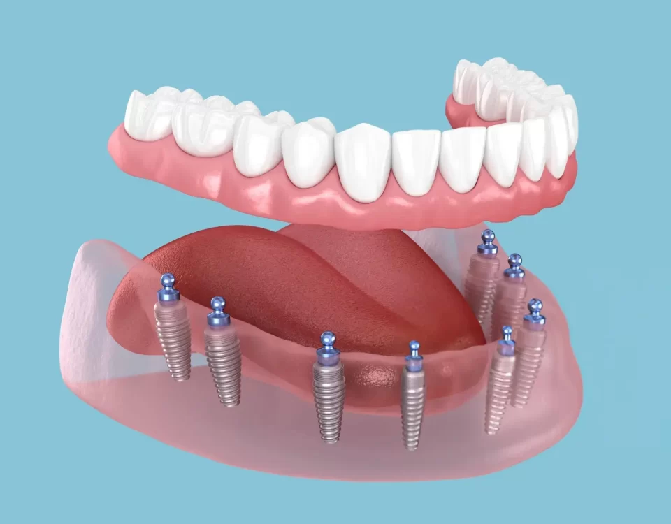 Full Dental Implants Costs
