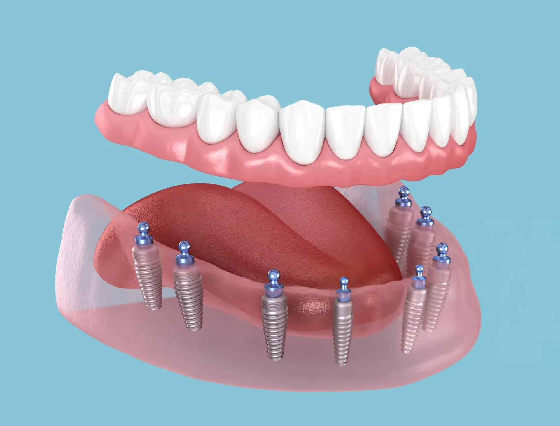Full Dental Implants Costs