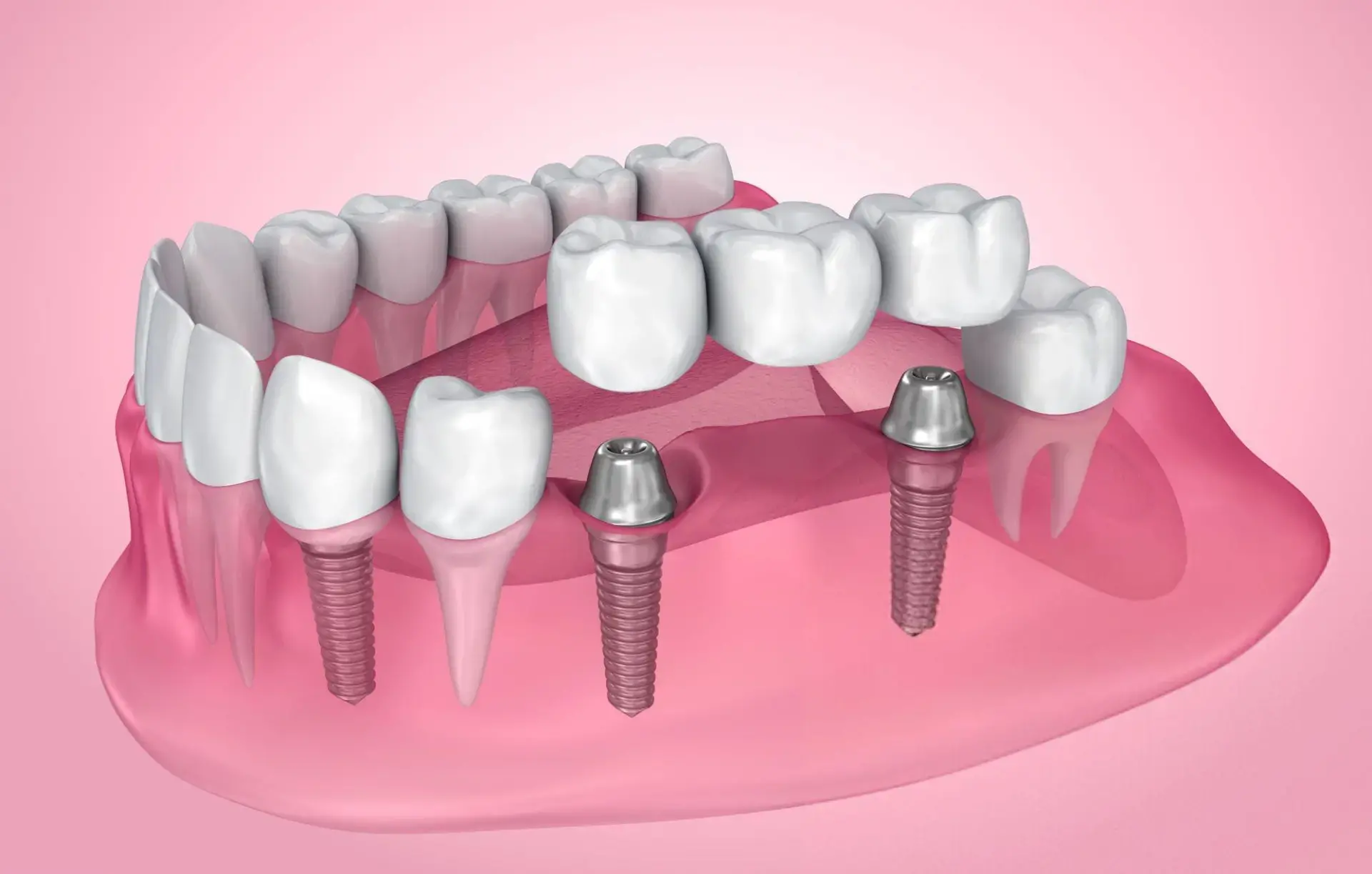 Skotzko Family Dental Clinic|Dental Implants