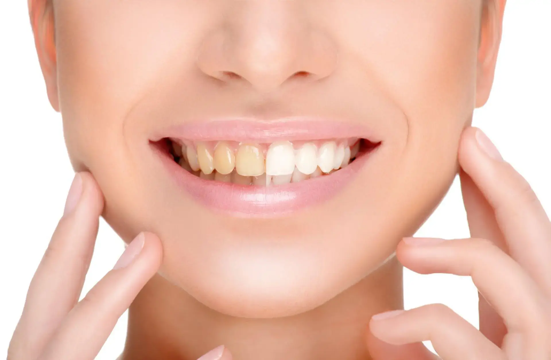 Smile Makeover Treatment