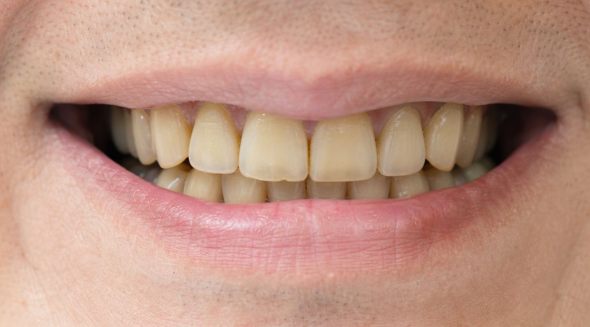 Skotzko Family Dental Clinic | What Causes Tooth Discoloration: Expert Answers When Discoloration Comes from Within