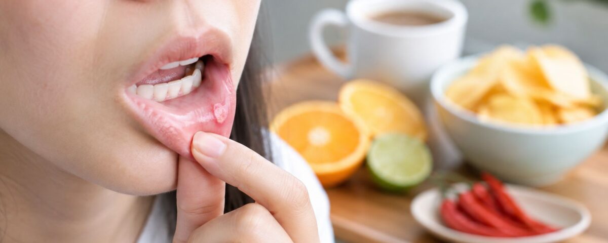 Skotzko Family Dental Clinic | Foods to Avoid with Canker Sores: A Cornelius Guide