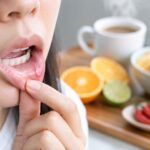 Skotzko Family Dental Clinic | What to Eat with Canker Sores: Soothe & Heal Fast