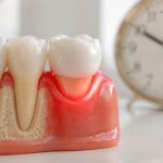 Skotzko Family Dental Clinic | Metal Porcelain Crowns vs Porcelain: A Cornelius Guide Skotzko Family Dental Clinic | Metal Porcelain Crowns vs Porcelain: A Cornelius Guide