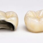 Skotzko Family Dental Clinic | How Long Does Sensitivity Last After Crown? Your Guide For Skotzko Family Dental Clinic | How Long Does Sensitivity Last After Crown? Your Guide For