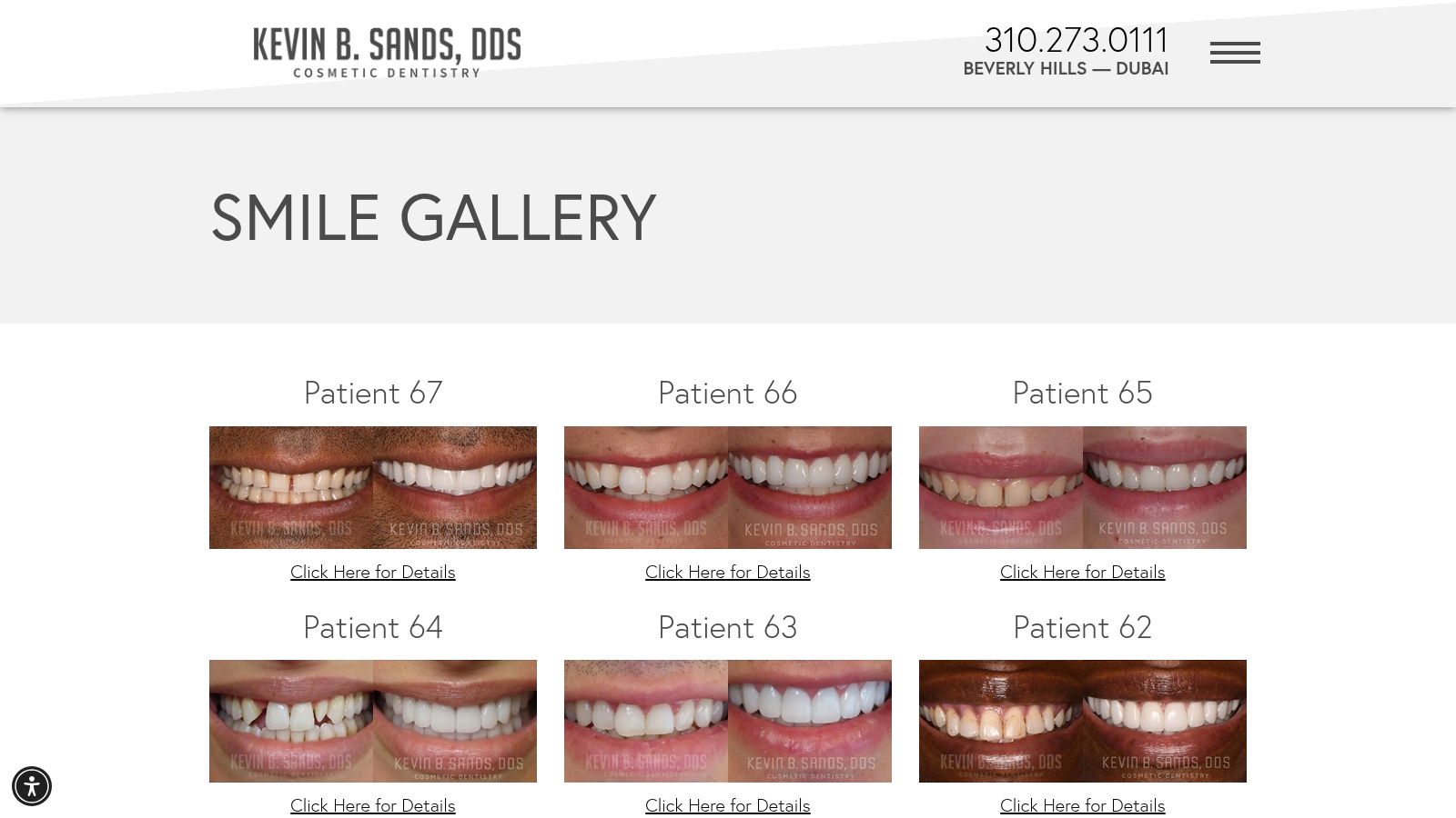 Skotzko Family Dental Clinic | Veneers Before and After: 7 Smile Stories from Cornelius, NC Case 3: Restoring a Smile Worn Down by Grinding